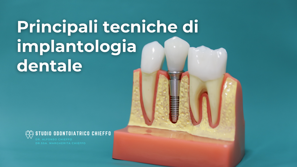Principali tecniche di implantologia dentale
